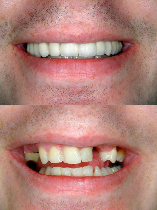 Teeth Filling Services in Cranston RI - Dental RI